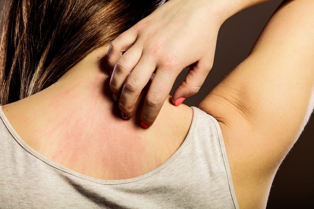 woman with allergies scratching her back