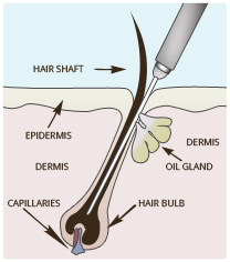 electrolysis hair removal diagram